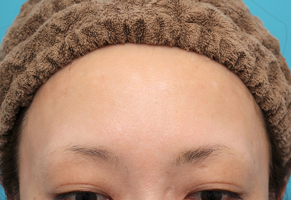 傷跡,額の水疱瘡跡を傷跡修正手術で綺麗にした20代女性の症例写真,After（6ヶ月後）,ba_keisei002_a01.jpg