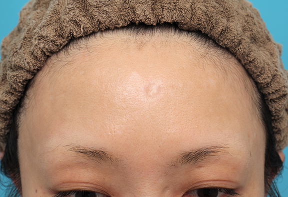 傷跡,額の水疱瘡跡を傷跡修正手術で綺麗にした20代女性の症例写真,Before,ba_keisei002_b01.jpg