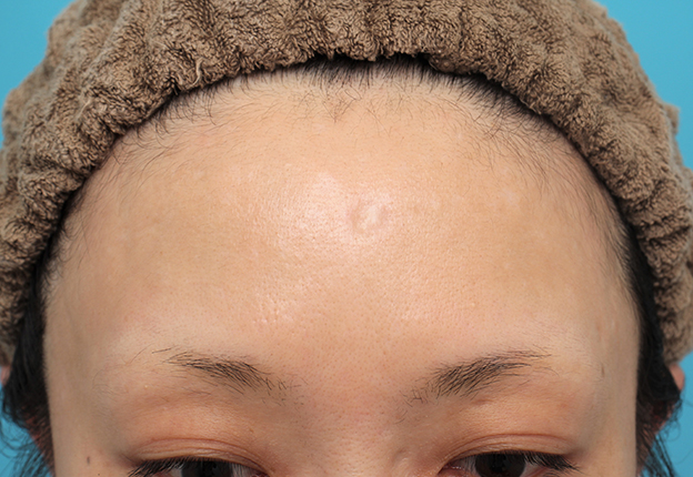 傷跡,額の水疱瘡跡を傷跡修正手術で綺麗にした20代女性の症例写真,手術前,mainpic_keisei002a.jpg