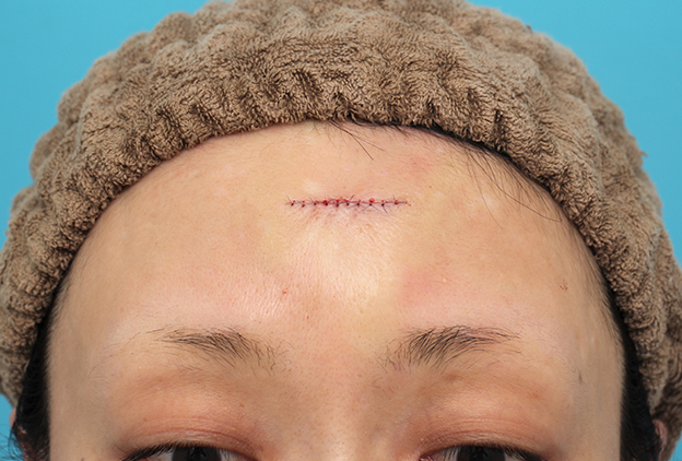 傷跡,額の水疱瘡跡を傷跡修正手術で綺麗にした20代女性の症例写真,手術直後,mainpic_keisei002b.jpg