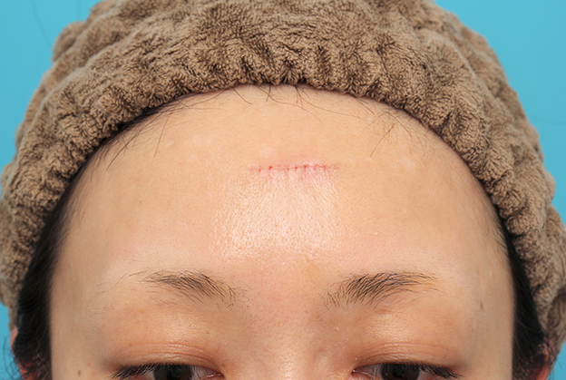 傷跡,額の水疱瘡跡を傷跡修正手術で綺麗にした20代女性の症例写真,6日後,mainpic_keisei002c.jpg