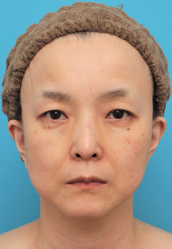 ミディアムリフト+目の下脂肪取りを行った50代女性の症例写真,After（6ヶ月後）,ba_mediumlift020_a01.jpg