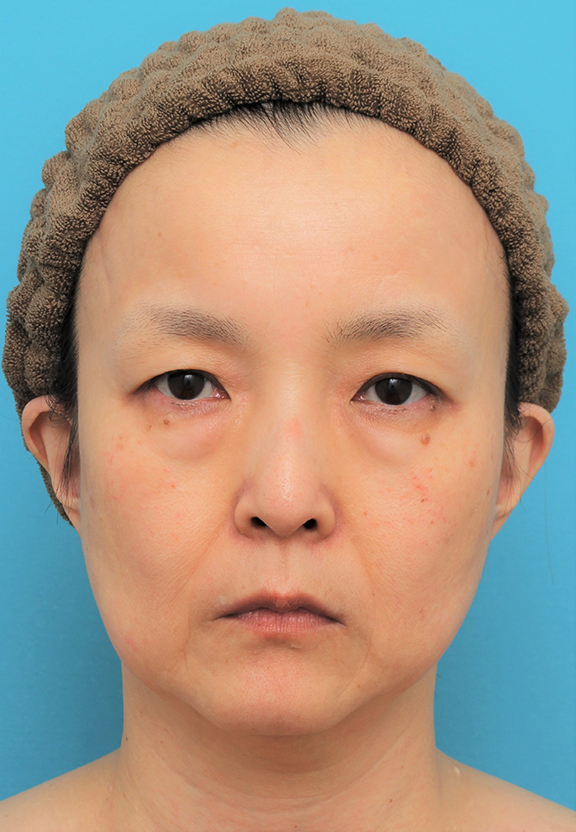 目の下の脂肪取り,ミディアムリフト+目の下脂肪取りを行った50代女性の症例写真,Before,ba_mediumlift020_b01.jpg