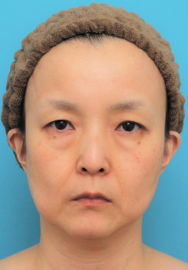 目の下の脂肪取り,ミディアムリフト+目の下脂肪取りを行った50代女性の症例写真,手術前,mainpic_mediumlift020a.jpg