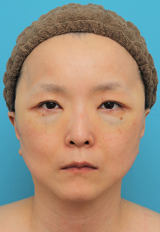 目の下の脂肪取り,ミディアムリフト+目の下脂肪取りを行った50代女性の症例写真,手術直後,mainpic_mediumlift020b.jpg