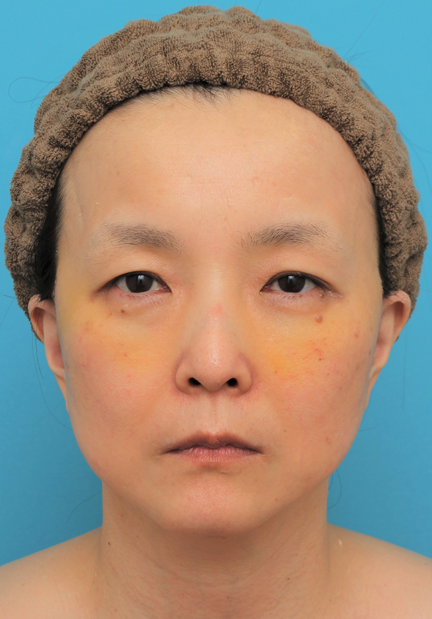 目の下の脂肪取り,ミディアムリフト+目の下脂肪取りを行った50代女性の症例写真,1週間後,mainpic_mediumlift020c.jpg