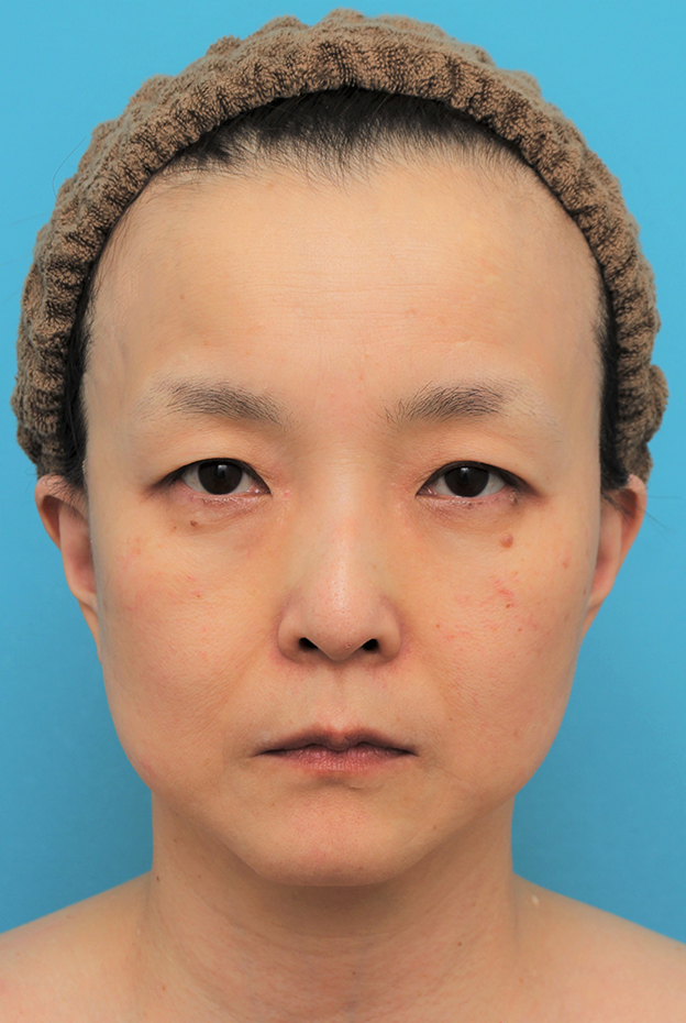 目の下の脂肪取り,ミディアムリフト+目の下脂肪取りを行った50代女性の症例写真,3週間後,mainpic_mediumlift020d.jpg