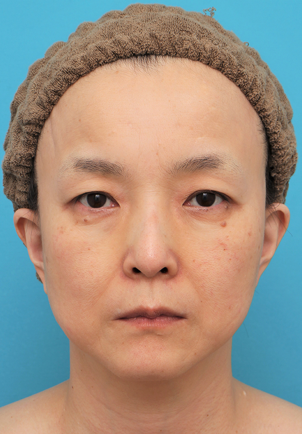 目の下の脂肪取り,ミディアムリフト+目の下脂肪取りを行った50代女性の症例写真,6ヶ月後,mainpic_mediumlift020e.jpg