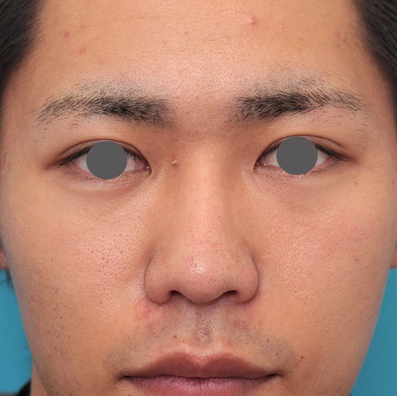 隆鼻術（シリコンプロテーゼ）,鼻プロテーゼ+鼻先耳介軟骨移植+小鼻縮小を行った20代男性の症例写真,After（6ヶ月後）,ba_ryubi1062_b01.jpg
