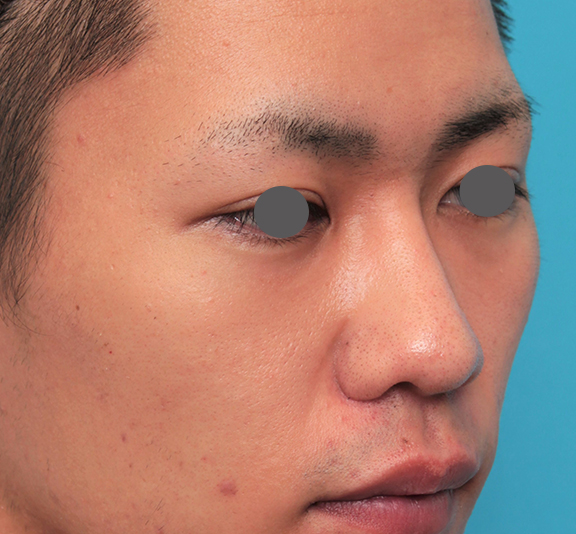 隆鼻術（シリコンプロテーゼ）,鼻プロテーゼ+鼻先耳介軟骨移植+小鼻縮小を行った20代男性の症例写真,After（6ヶ月後）,ba_ryubi1062_b02.jpg