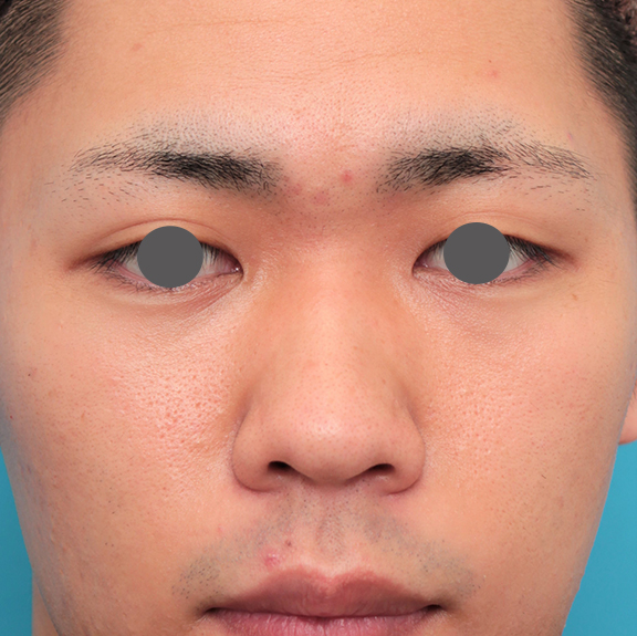 鼻翼縮小（小鼻縮小）,鼻プロテーゼ+鼻先耳介軟骨移植+小鼻縮小を行った20代男性の症例写真,Before,ba_ryubi1062_b01.jpg