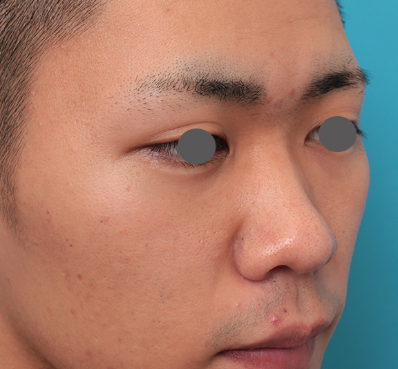 鼻翼縮小（小鼻縮小）,鼻プロテーゼ+鼻先耳介軟骨移植+小鼻縮小を行った20代男性の症例写真,Before,ba_ryubi1062_b02.jpg