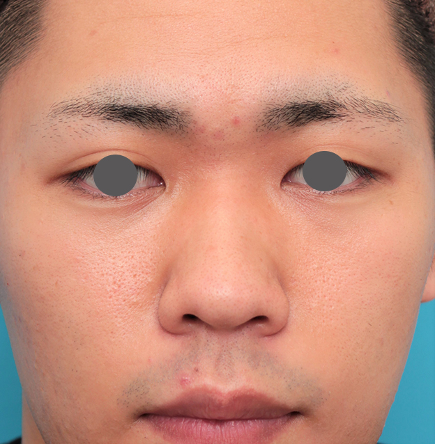 隆鼻術（シリコンプロテーゼ）,鼻プロテーゼ+鼻先耳介軟骨移植+小鼻縮小を行った20代男性の症例写真,手術前,mainpic_ryubi1062a.jpg