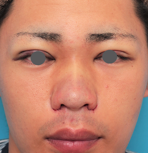 隆鼻術（シリコンプロテーゼ）,鼻プロテーゼ+鼻先耳介軟骨移植+小鼻縮小を行った20代男性の症例写真,手術直後,mainpic_ryubi1062b.jpg