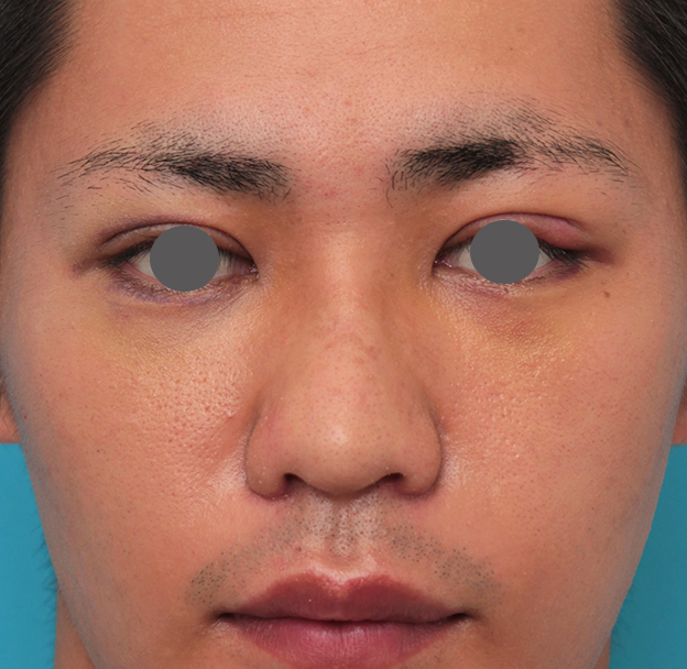 隆鼻術（シリコンプロテーゼ）,鼻プロテーゼ+鼻先耳介軟骨移植+小鼻縮小を行った20代男性の症例写真,6日後,mainpic_ryubi1062c.jpg