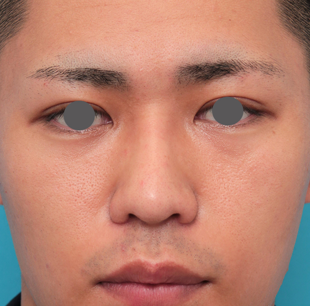 隆鼻術（シリコンプロテーゼ）,鼻プロテーゼ+鼻先耳介軟骨移植+小鼻縮小を行った20代男性の症例写真,3週間後,mainpic_ryubi1062d.jpg