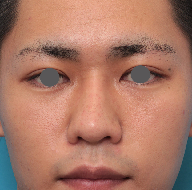 耳介軟骨移植（鼻先を出す）,鼻プロテーゼ+鼻先耳介軟骨移植+小鼻縮小を行った20代男性の症例写真,2ヶ月後,mainpic_ryubi1062e.jpg