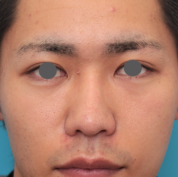 隆鼻術（シリコンプロテーゼ）,鼻プロテーゼ+鼻先耳介軟骨移植+小鼻縮小を行った20代男性の症例写真,6ヶ月後,mainpic_ryubi1062f.jpg