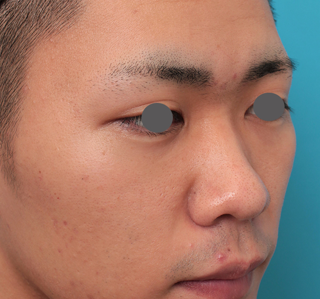 隆鼻術（シリコンプロテーゼ）,鼻プロテーゼ+鼻先耳介軟骨移植+小鼻縮小を行った20代男性の症例写真,手術前,mainpic_ryubi1062g.jpg