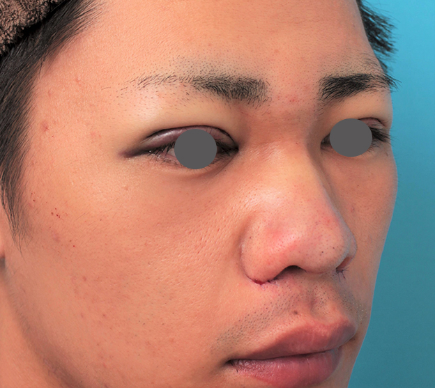 鼻翼縮小（小鼻縮小）,鼻プロテーゼ+鼻先耳介軟骨移植+小鼻縮小を行った20代男性の症例写真,手術直後,mainpic_ryubi1062h.jpg