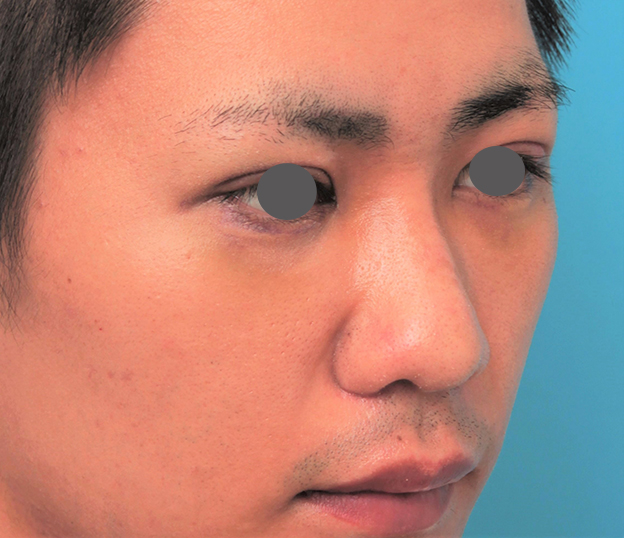 鼻翼縮小（小鼻縮小）,鼻プロテーゼ+鼻先耳介軟骨移植+小鼻縮小を行った20代男性の症例写真,6日後,mainpic_ryubi1062i.jpg
