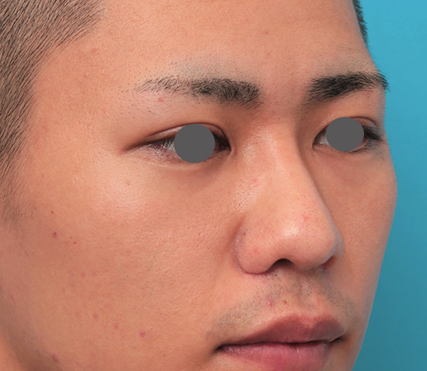鼻翼縮小（小鼻縮小）,鼻プロテーゼ+鼻先耳介軟骨移植+小鼻縮小を行った20代男性の症例写真,3週間後,mainpic_ryubi1062j.jpg