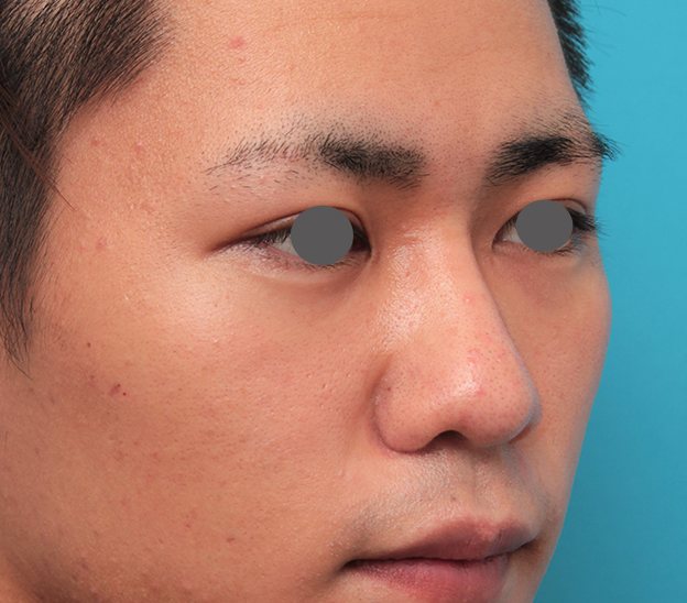 隆鼻術（シリコンプロテーゼ）,鼻プロテーゼ+鼻先耳介軟骨移植+小鼻縮小を行った20代男性の症例写真,2ヶ月後,mainpic_ryubi1062k.jpg