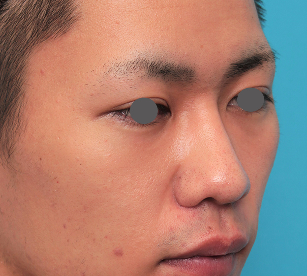 症例写真,鼻プロテーゼ+鼻先耳介軟骨移植+小鼻縮小を行った20代男性の症例写真,6ヶ月後,mainpic_ryubi1062l.jpg