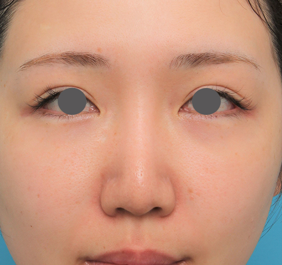 鼻翼縮小（小鼻縮小）,鼻プロテーゼ+鼻柱の耳介軟骨移植+小鼻縮小を行った20代女性の症例写真,After（6ヶ月後）,ba_ryubi1063_b01.jpg