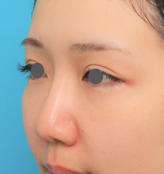 耳介軟骨移植（鼻先を出す）,鼻プロテーゼ+鼻柱の耳介軟骨移植+小鼻縮小を行った20代女性の症例写真,After（6ヶ月後）,ba_ryubi1063_b02.jpg