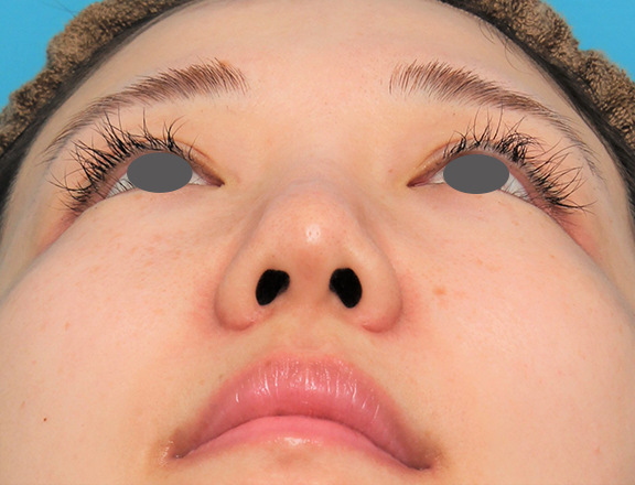 耳介軟骨移植（鼻先を出す）,鼻プロテーゼ+鼻柱の耳介軟骨移植+小鼻縮小を行った20代女性の症例写真,After（6ヶ月後）,ba_ryubi1063_b03.jpg