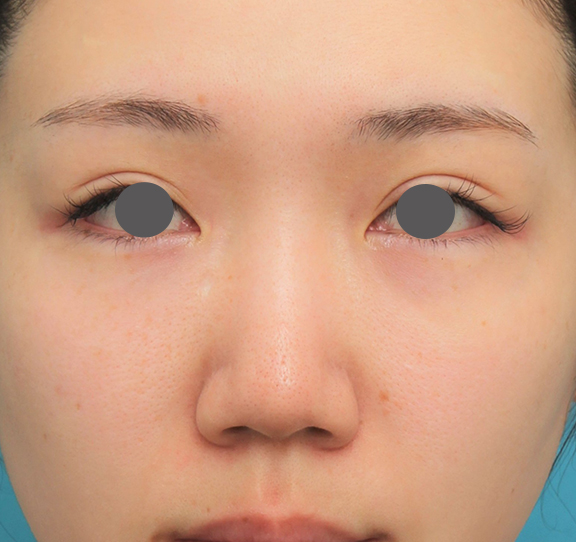 隆鼻術（シリコンプロテーゼ）,鼻プロテーゼ+鼻柱の耳介軟骨移植+小鼻縮小を行った20代女性の症例写真,Before,ba_ryubi1063_b01.jpg