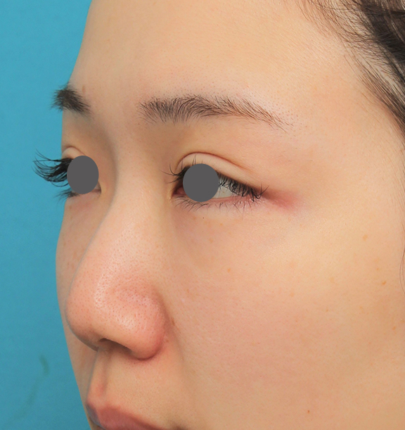 隆鼻術（シリコンプロテーゼ）,鼻プロテーゼ+鼻柱の耳介軟骨移植+小鼻縮小を行った20代女性の症例写真,Before,ba_ryubi1063_b02.jpg