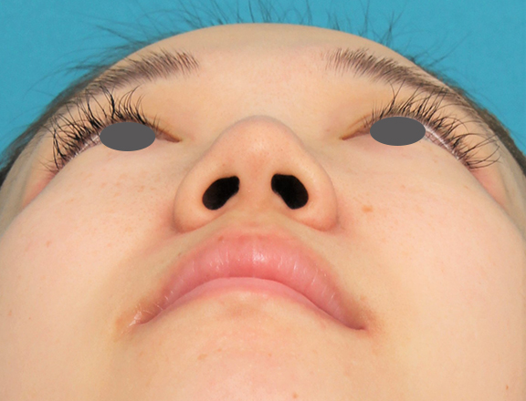 症例写真,鼻プロテーゼ+鼻柱の耳介軟骨移植+小鼻縮小を行った20代女性の症例写真,Before,ba_ryubi1063_b03.jpg