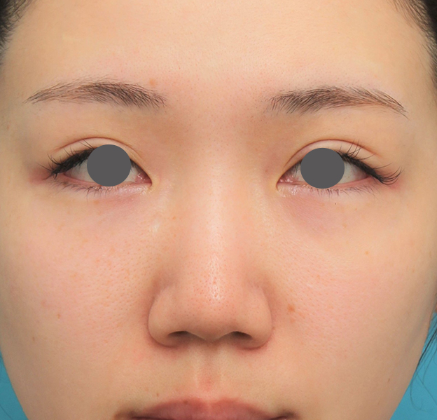 耳介軟骨移植（鼻先を出す）,鼻プロテーゼ+鼻柱の耳介軟骨移植+小鼻縮小を行った20代女性の症例写真,手術前,mainpic_ryubi1063a.jpg