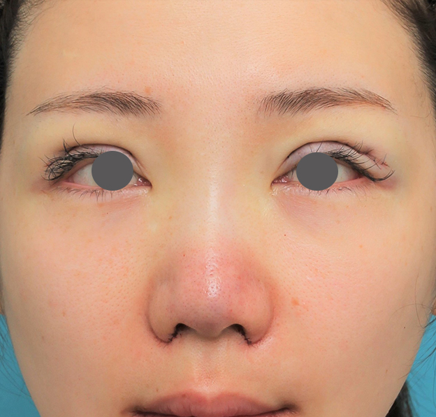 隆鼻術（シリコンプロテーゼ）,鼻プロテーゼ+鼻柱の耳介軟骨移植+小鼻縮小を行った20代女性の症例写真,手術直後,mainpic_ryubi1063b.jpg