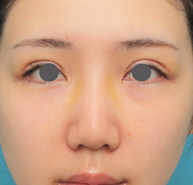 鼻翼縮小（小鼻縮小）,鼻プロテーゼ+鼻柱の耳介軟骨移植+小鼻縮小を行った20代女性の症例写真,6日後,mainpic_ryubi1063c.jpg