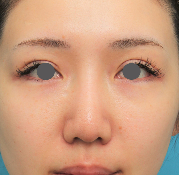 隆鼻術（シリコンプロテーゼ）,鼻プロテーゼ+鼻柱の耳介軟骨移植+小鼻縮小を行った20代女性の症例写真,3週間後,mainpic_ryubi1063d.jpg