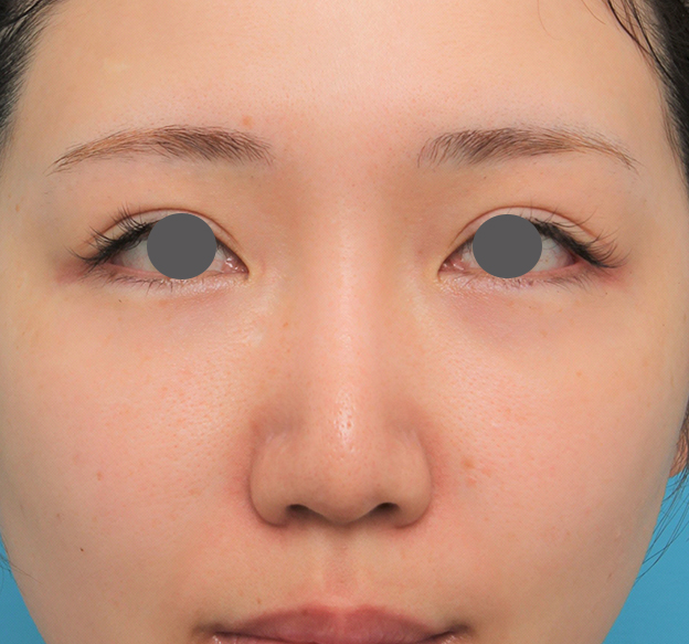 隆鼻術（シリコンプロテーゼ）,鼻プロテーゼ+鼻柱の耳介軟骨移植+小鼻縮小を行った20代女性の症例写真,6ヶ月後,mainpic_ryubi1063e.jpg
