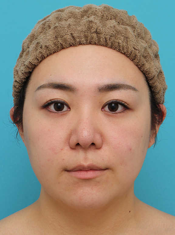 脂肪吸引（頬、あご）,脂肪吸引,頬～フェイスライン～顎下の脂肪吸引をした20代女性の症例写真,After（3ヶ月後）,ba_shibokyuin047_a01.jpg