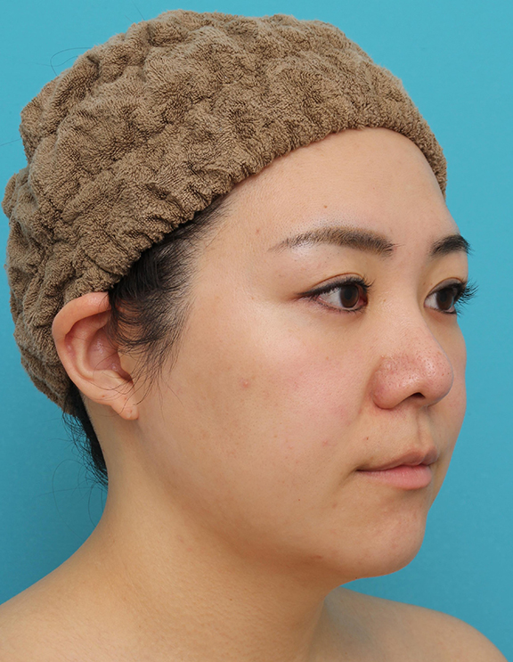 脂肪吸引（頬、あご）,頬～フェイスライン～顎下の脂肪吸引をした20代女性の症例写真,After（3ヶ月後）,ba_shibokyuin047_b02.jpg