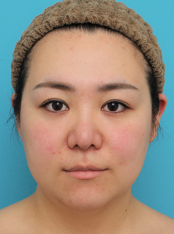 脂肪吸引（頬、あご）,脂肪吸引,頬～フェイスライン～顎下の脂肪吸引をした20代女性の症例写真,Before,ba_shibokyuin047_b01.jpg