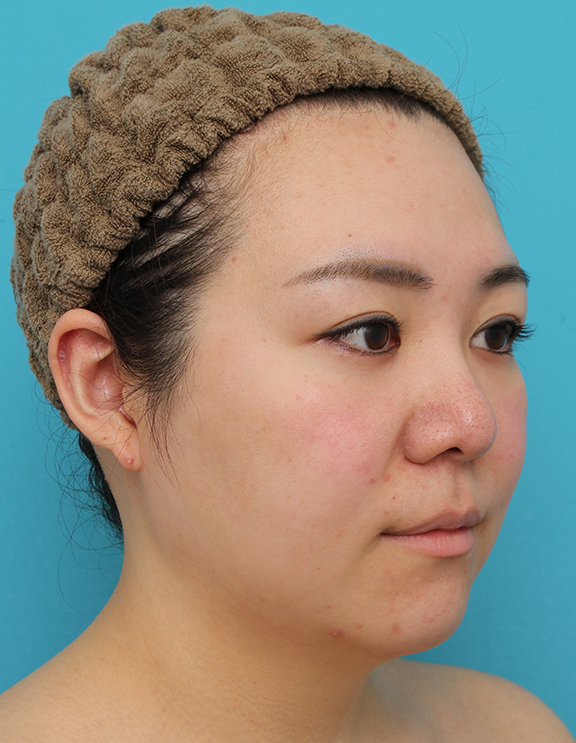 脂肪吸引（頬、あご）,頬～フェイスライン～顎下の脂肪吸引をした20代女性の症例写真,Before,ba_shibokyuin047_b02.jpg