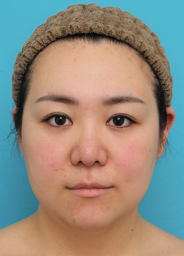 脂肪吸引（頬、あご）,頬～フェイスライン～顎下の脂肪吸引をした20代女性の症例写真,手術前,mainpic_shibokyuin047a.jpg