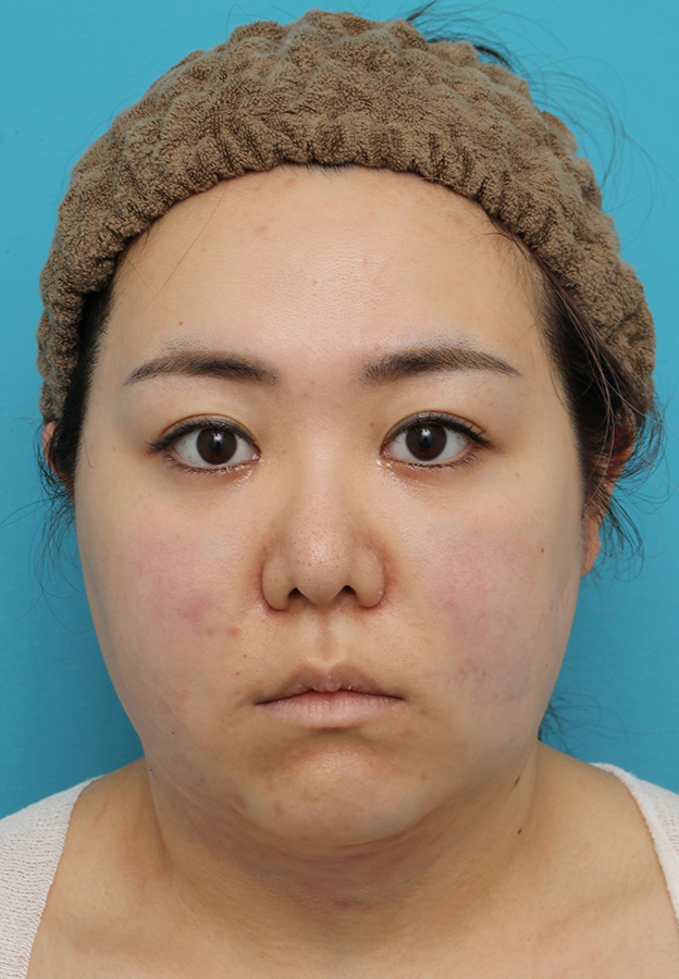 脂肪吸引（頬、あご）,頬～フェイスライン～顎下の脂肪吸引をした20代女性の症例写真,手術直後,mainpic_shibokyuin047b.jpg