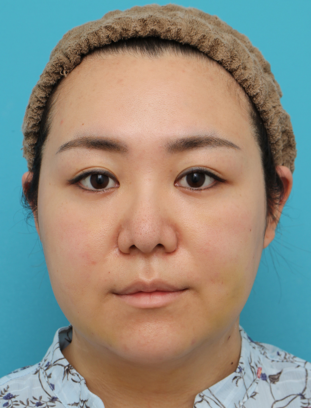 脂肪吸引（頬、あご）,頬～フェイスライン～顎下の脂肪吸引をした20代女性の症例写真,1週間後,mainpic_shibokyuin047c.jpg