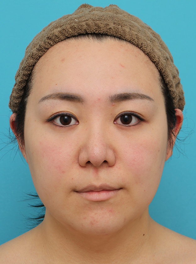 脂肪吸引（頬、あご）,頬～フェイスライン～顎下の脂肪吸引をした20代女性の症例写真,3週間後,mainpic_shibokyuin047d.jpg