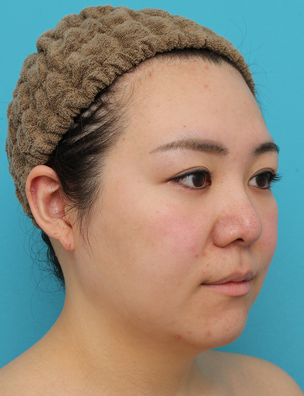脂肪吸引（頬、あご）,頬～フェイスライン～顎下の脂肪吸引をした20代女性の症例写真,手術前,mainpic_shibokyuin047f.jpg