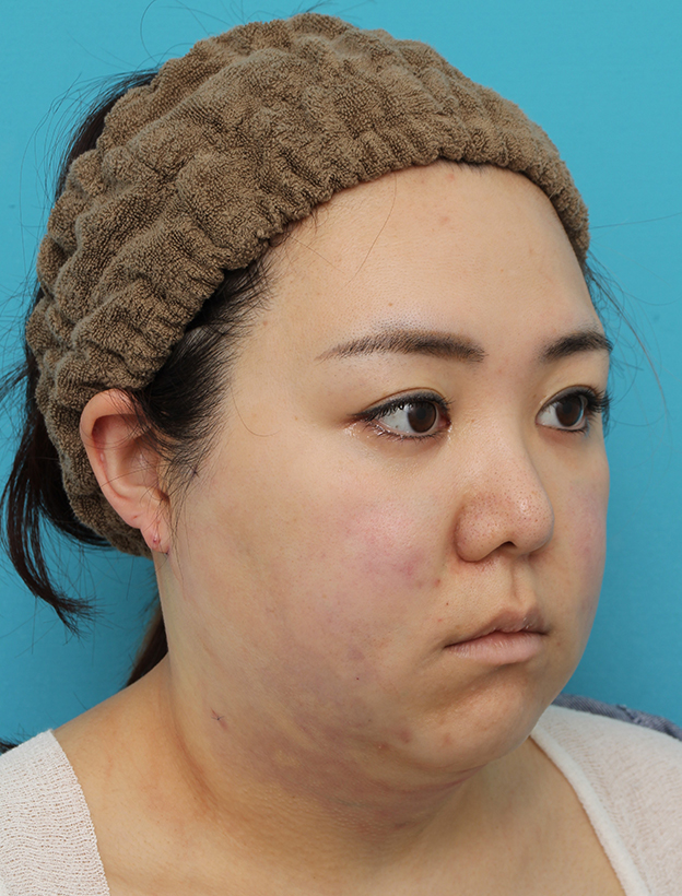 脂肪吸引（頬、あご）,頬～フェイスライン～顎下の脂肪吸引をした20代女性の症例写真,手術直後,mainpic_shibokyuin047g.jpg