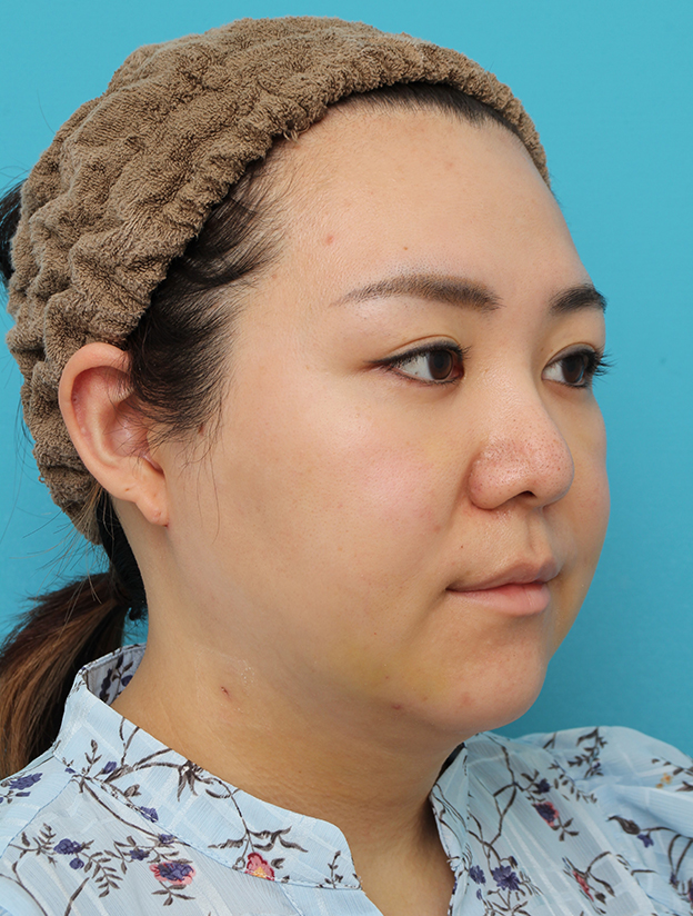 症例写真,頬～フェイスライン～顎下の脂肪吸引をした20代女性の症例写真,1週間後,mainpic_shibokyuin047h.jpg